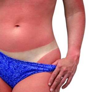 bad sunburn