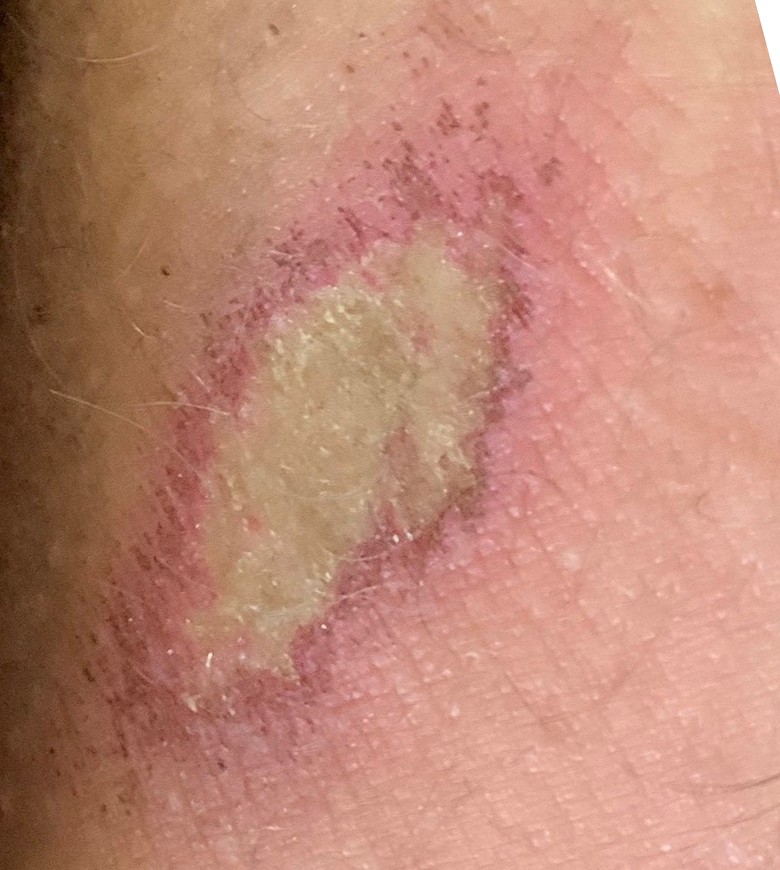 Ouch!